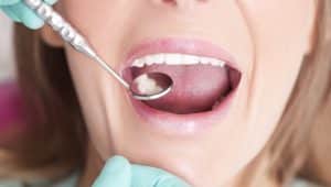 restauração do dente