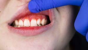 sangramento na gengiva