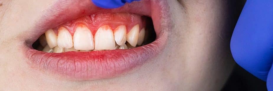 sangramento na gengiva