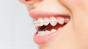 aparelho ortodôntico