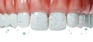 Remineralização do dente: o que é, como funciona e como proteger o esmalte
