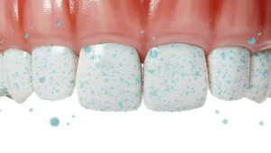 Remineralização do dente: o que é, como funciona e como proteger o esmalte